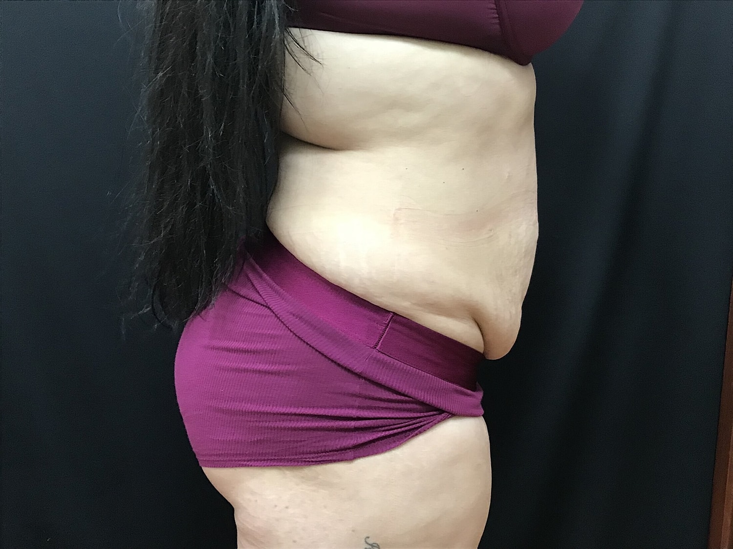 Tummy Tuck Before & After