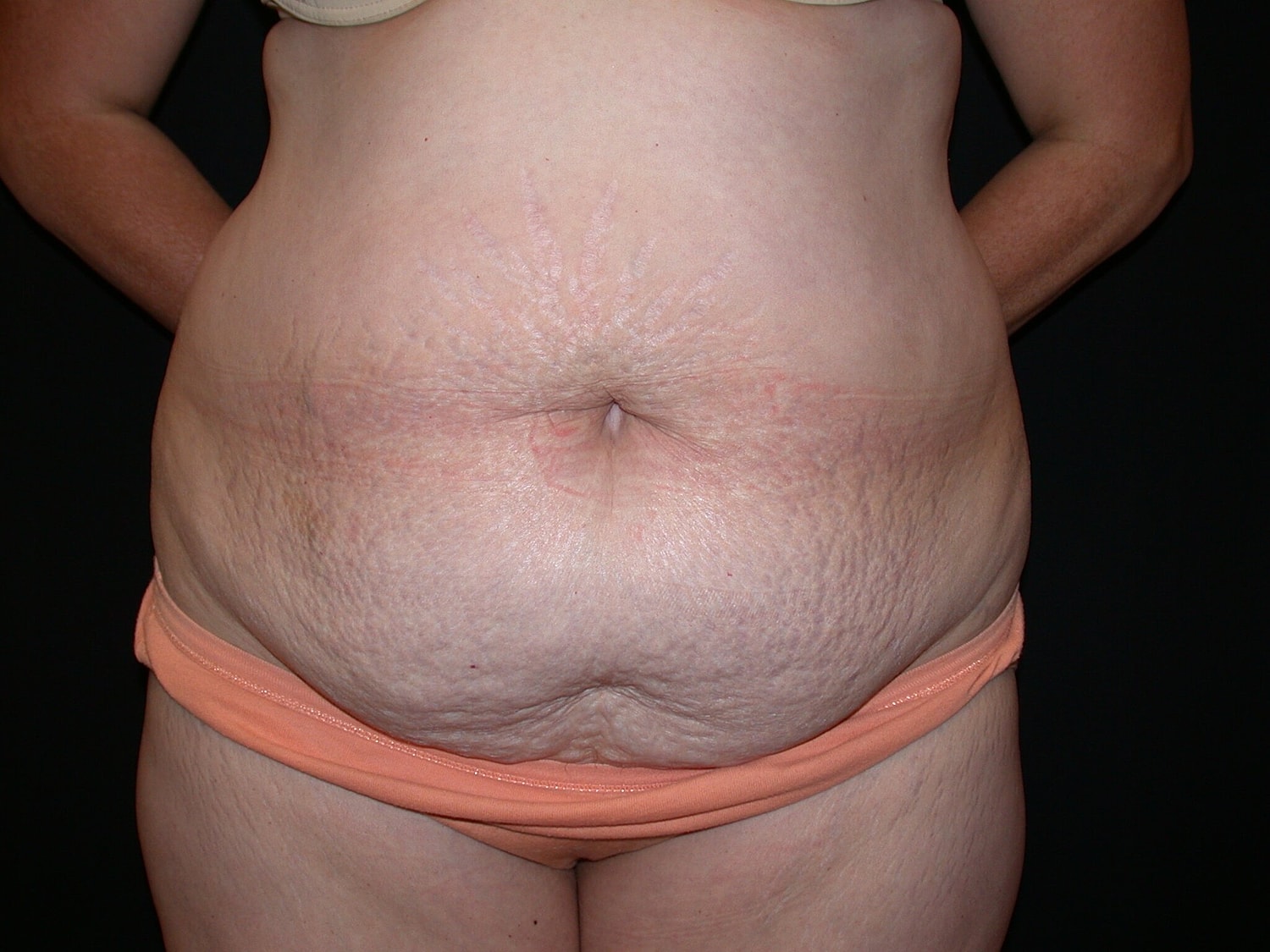 Tummy Tuck Before & After