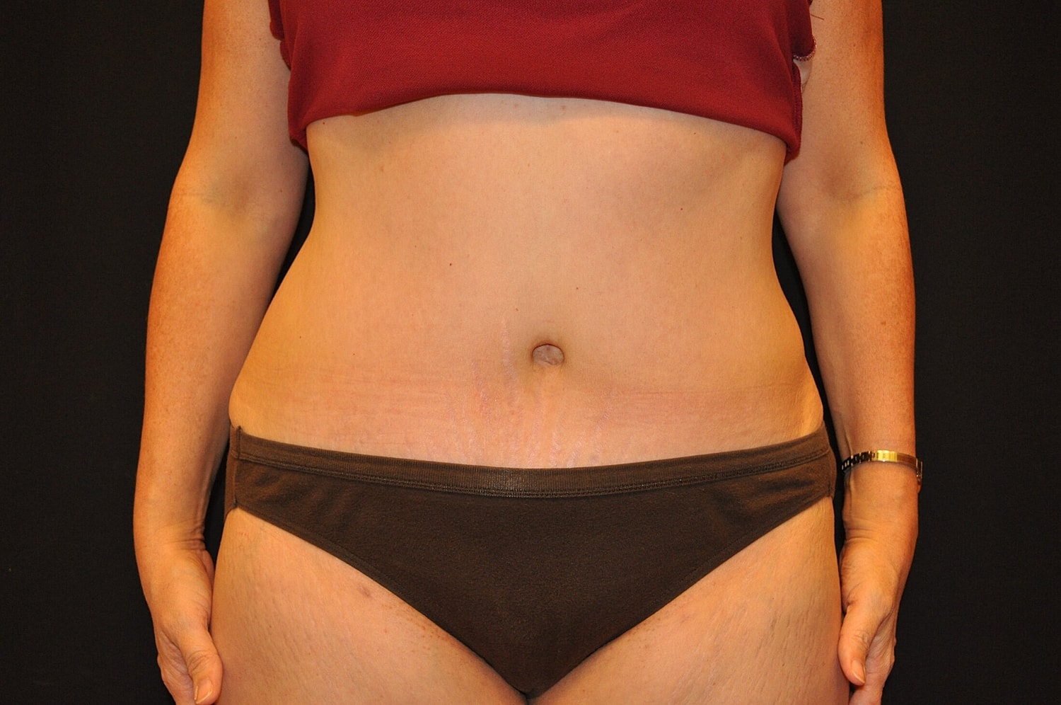 Tummy Tuck Before & After