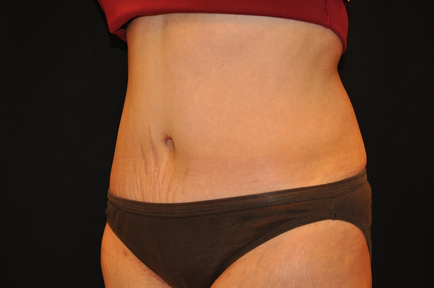 Tummy Tuck Before & After