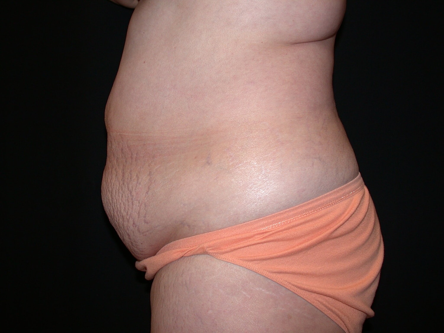 Tummy Tuck Before & After