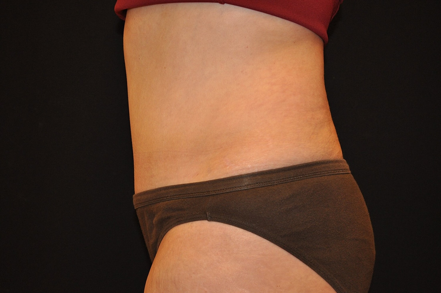 Tummy Tuck Before & After