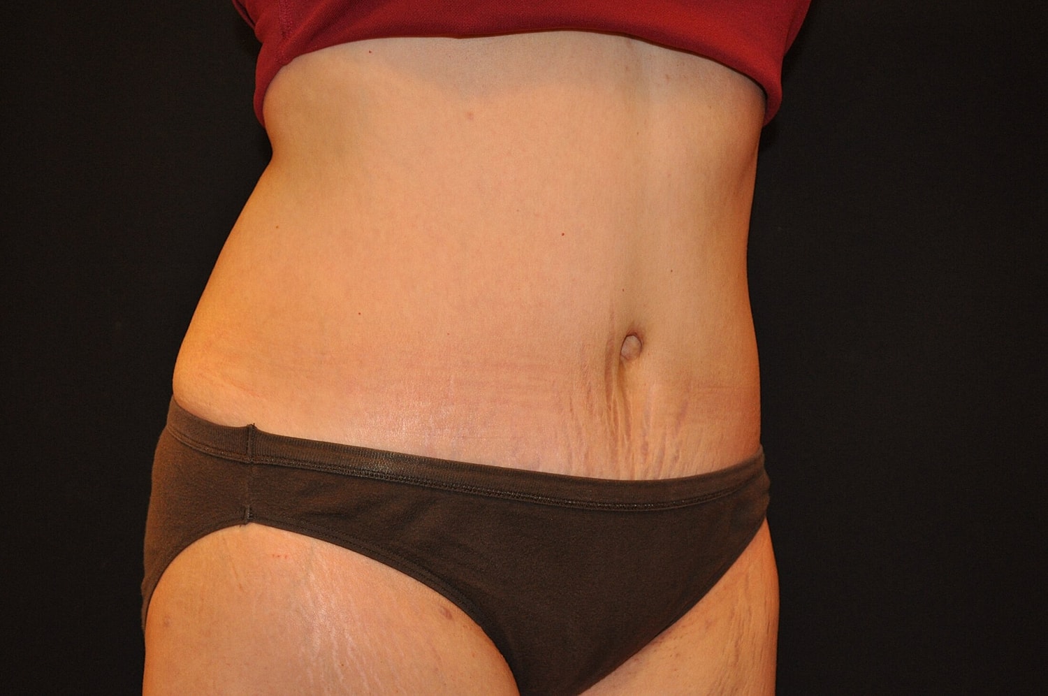 Tummy Tuck Before & After