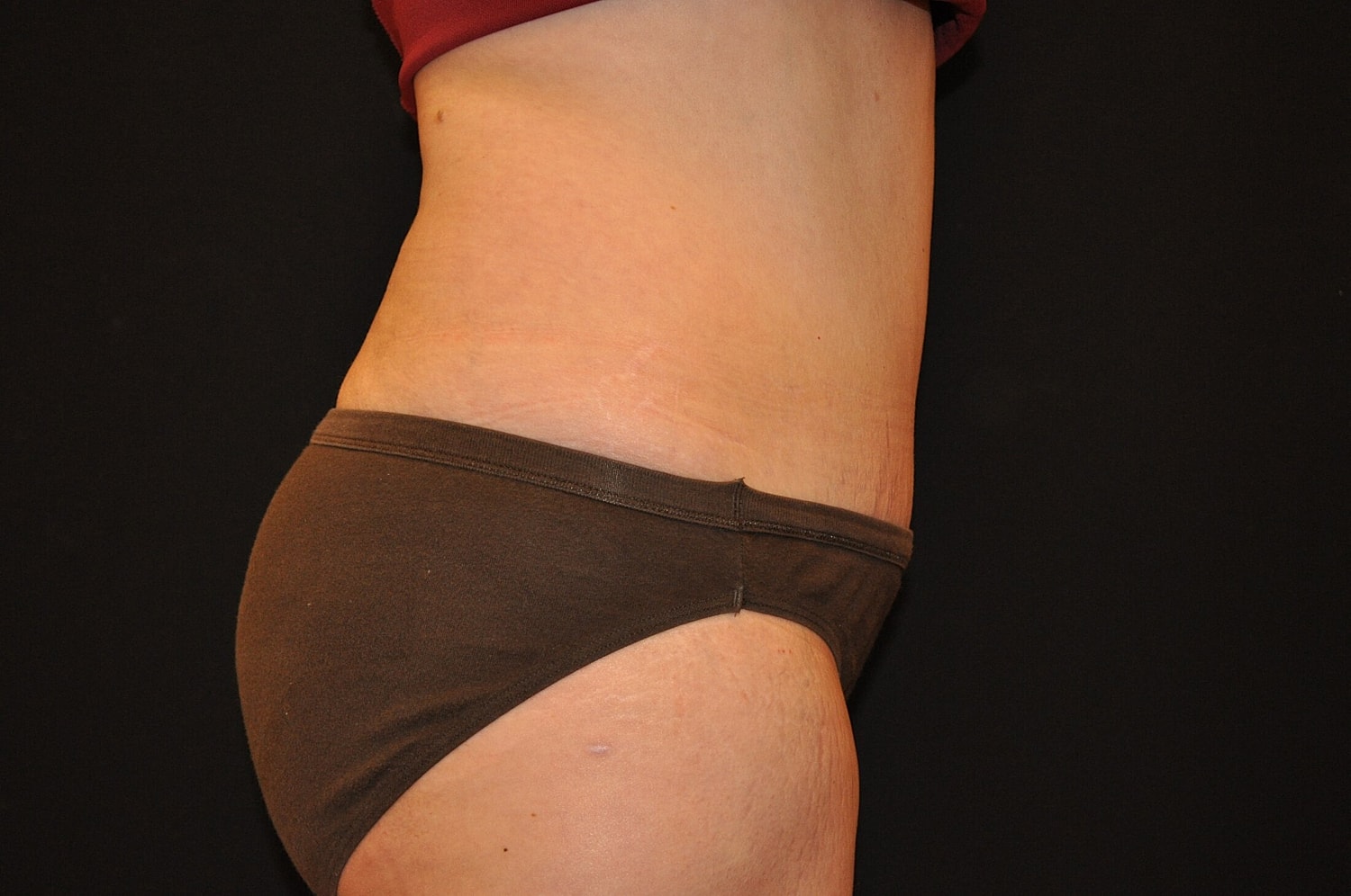 Tummy Tuck Before & After