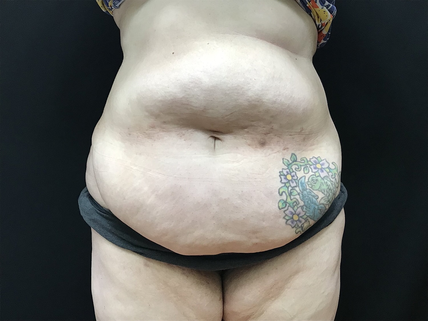 Tummy Tuck Before & After
