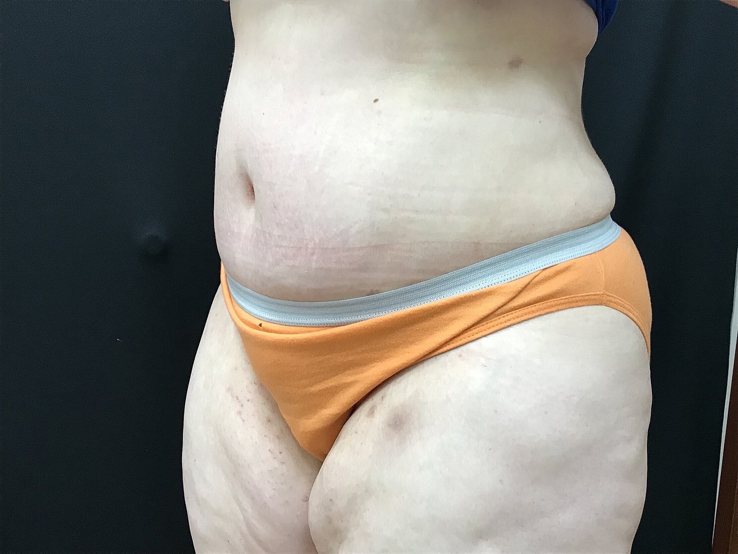 Tummy Tuck Before & After