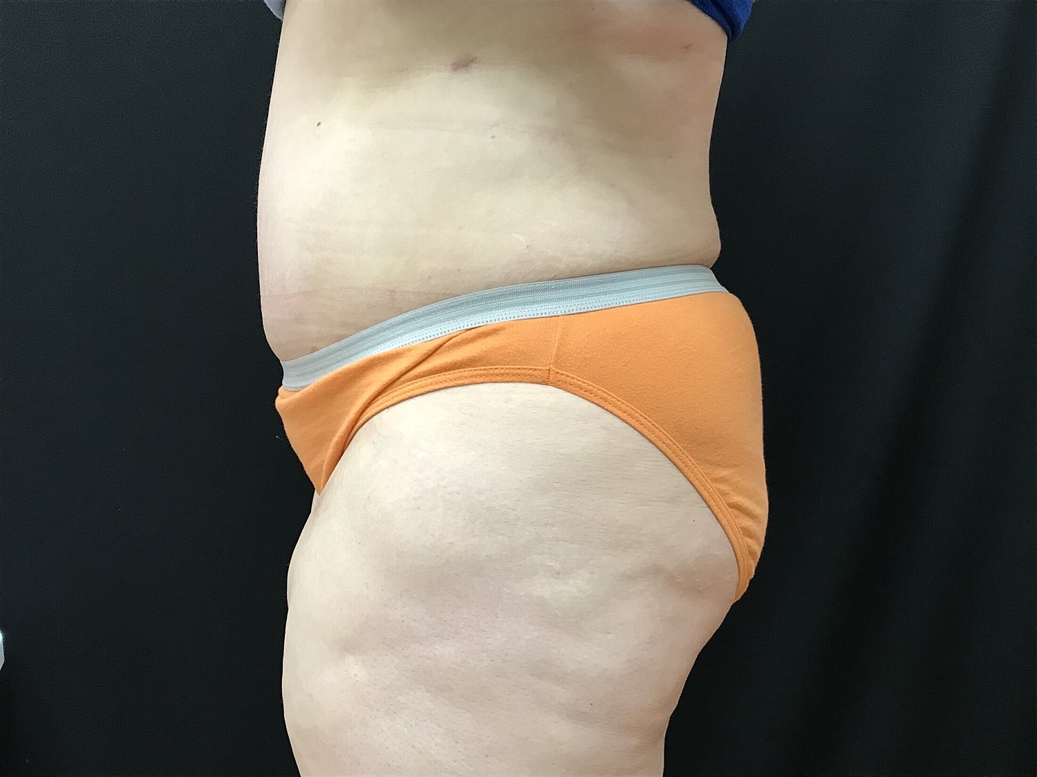 Tummy Tuck Before & After