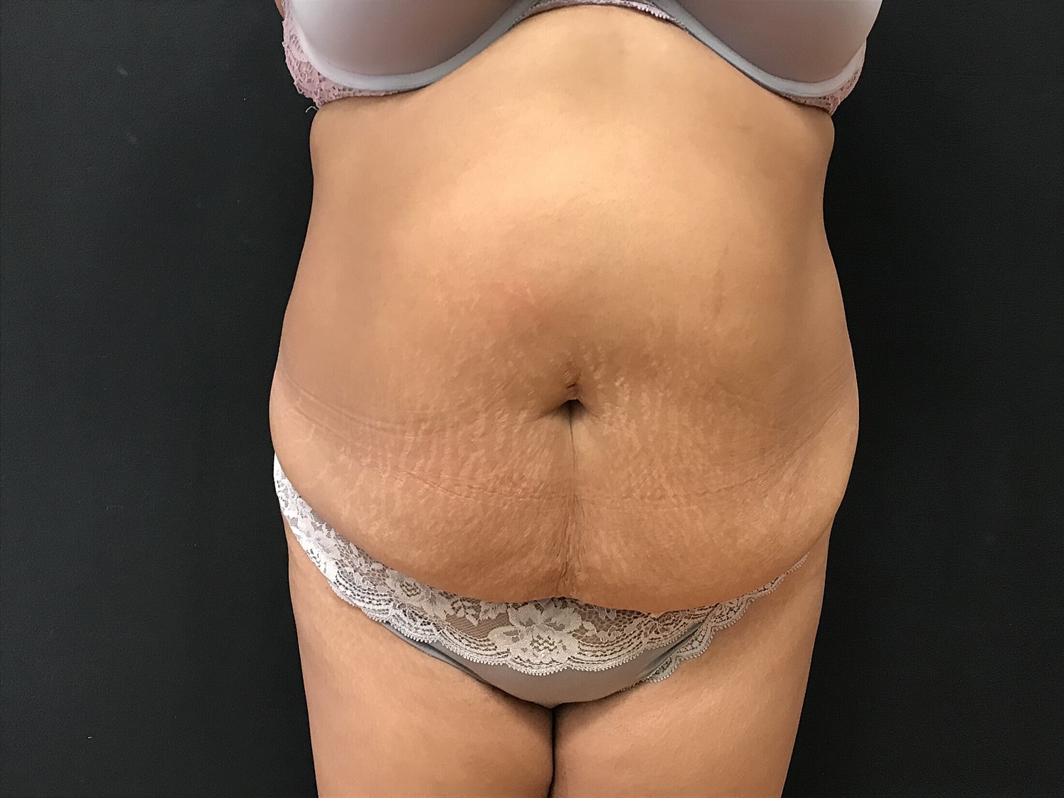 Tummy Tuck Before & After