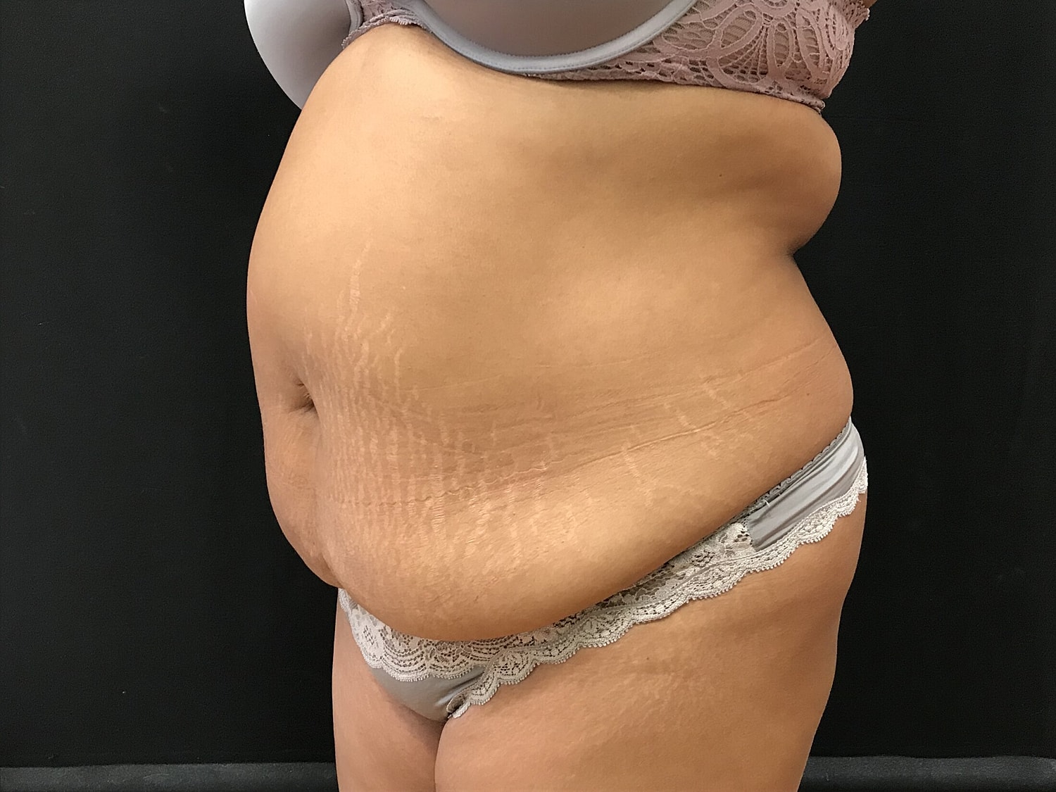 Tummy Tuck Before & After