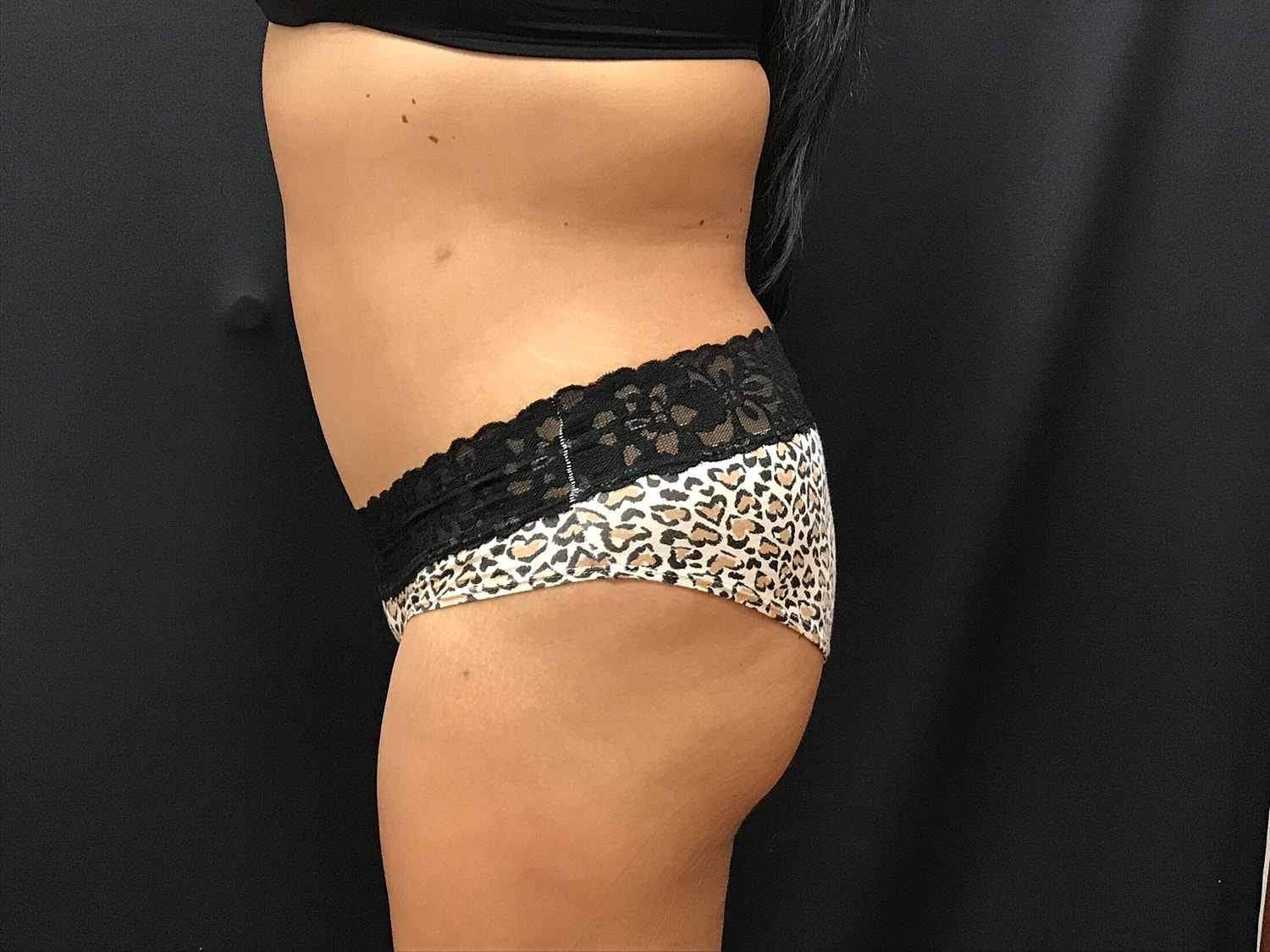 Tummy Tuck Before & After