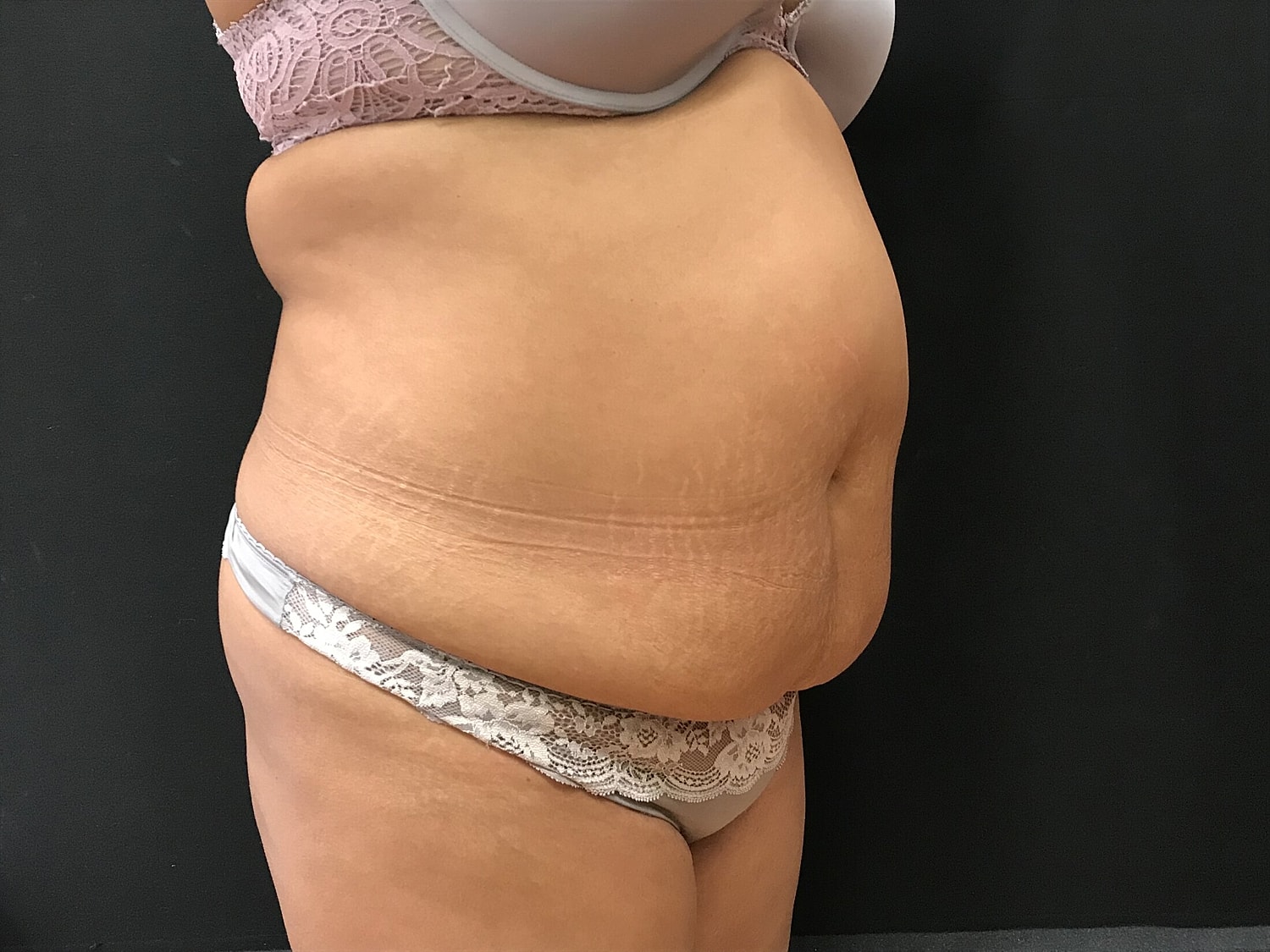 Tummy Tuck Before & After