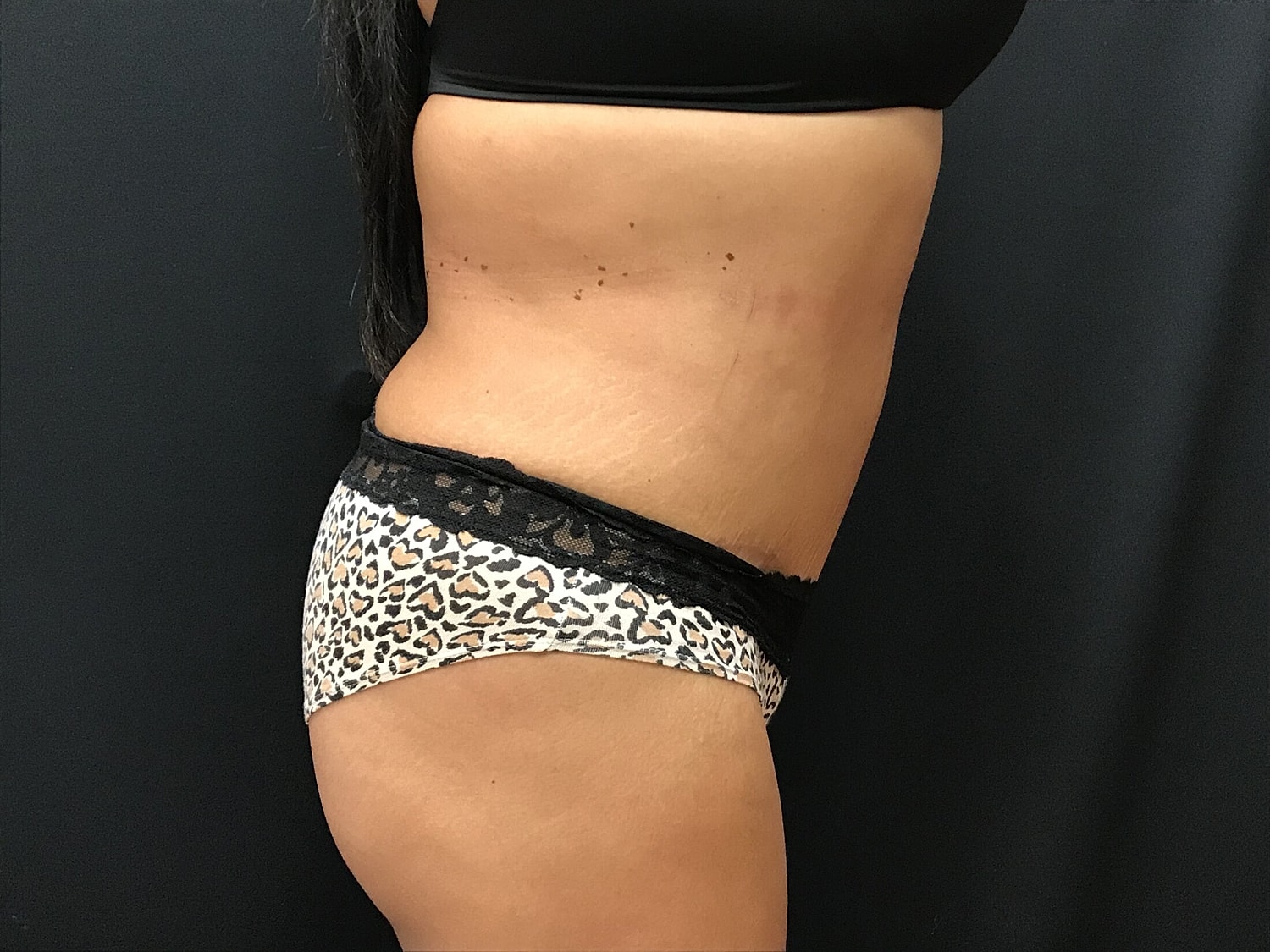 Tummy Tuck Before & After