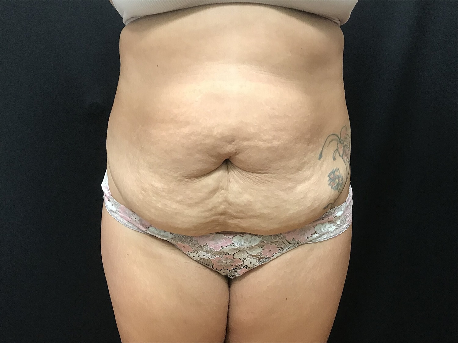 Tummy Tuck Before & After