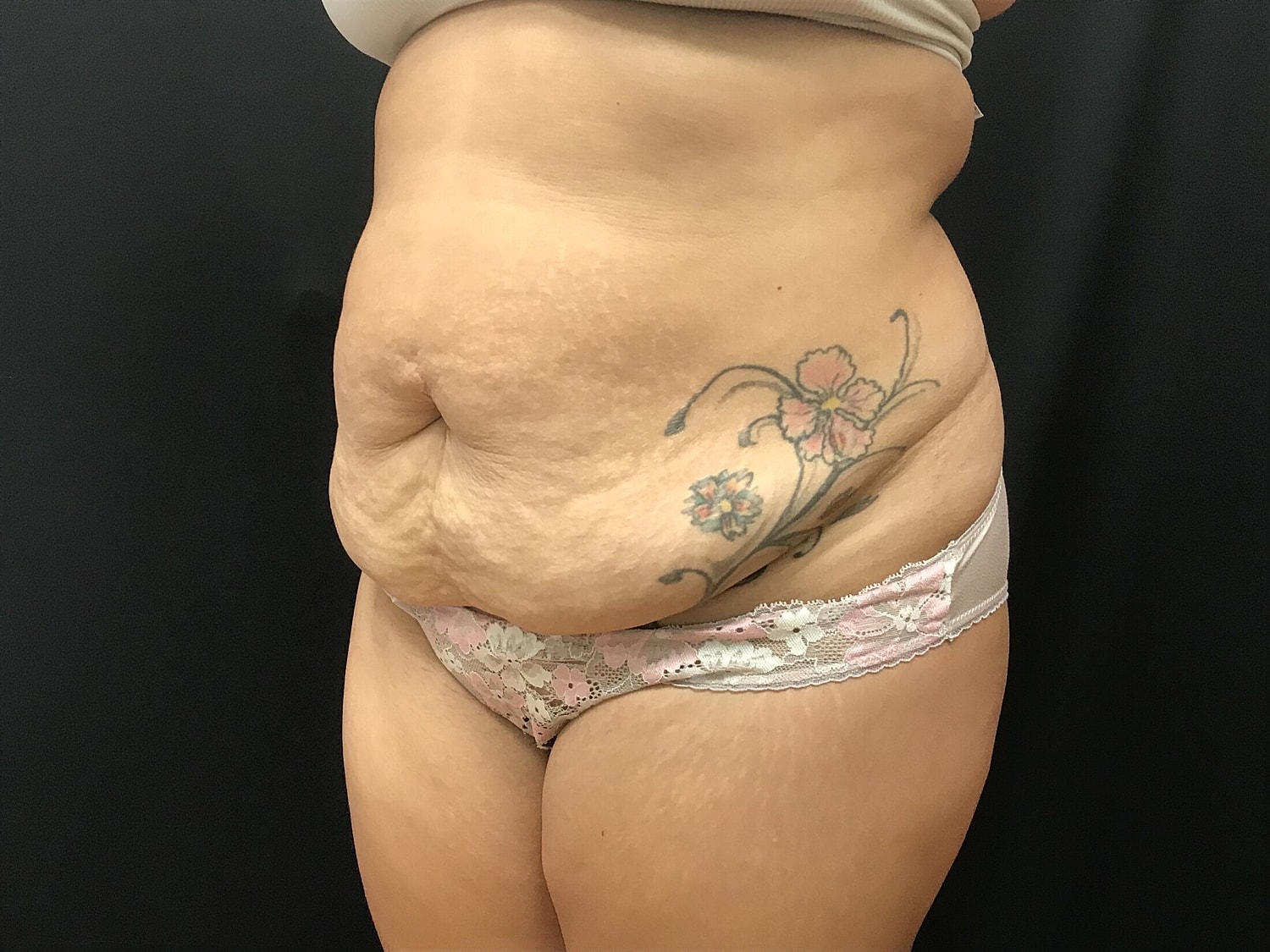 Tummy Tuck Before & After