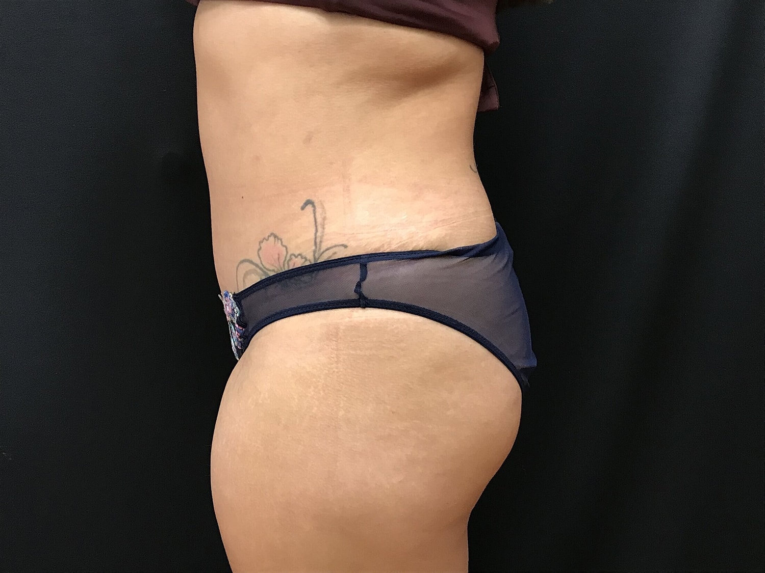 Tummy Tuck Before & After