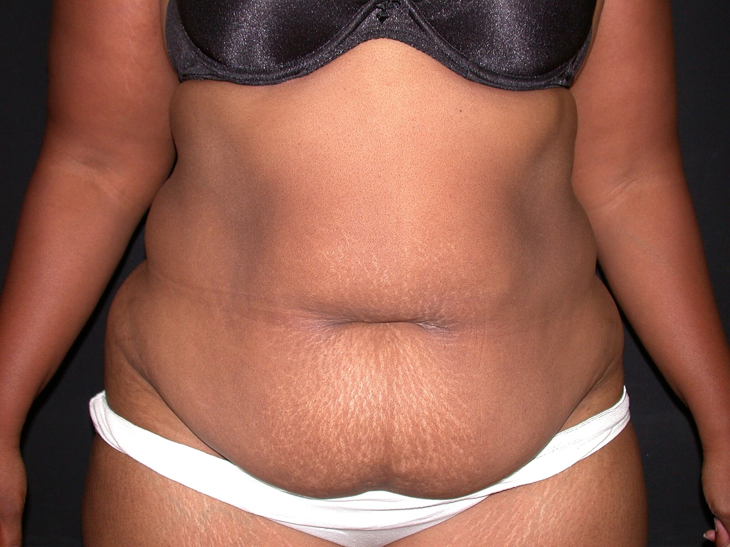 Tummy Tuck Before & After