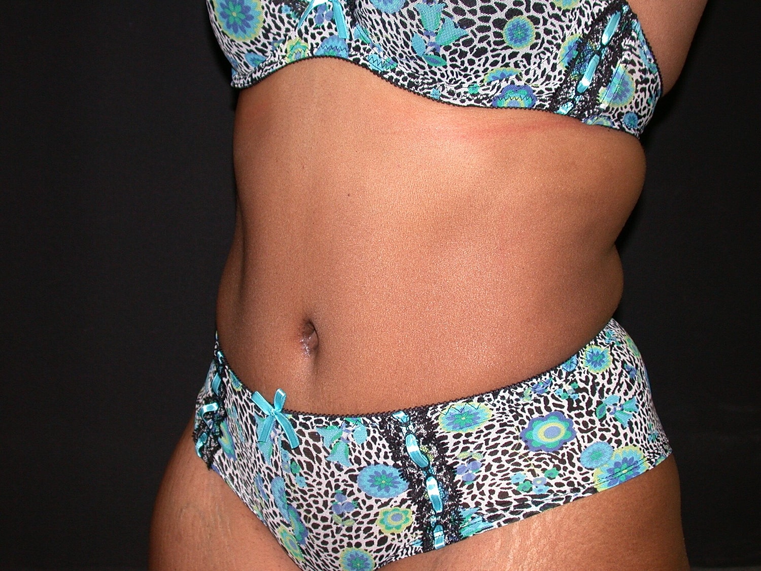 Tummy Tuck Before & After