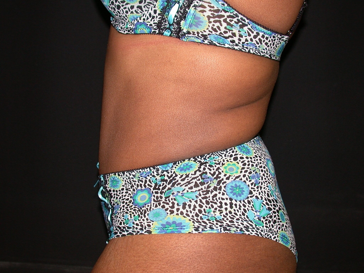 Tummy Tuck Before & After