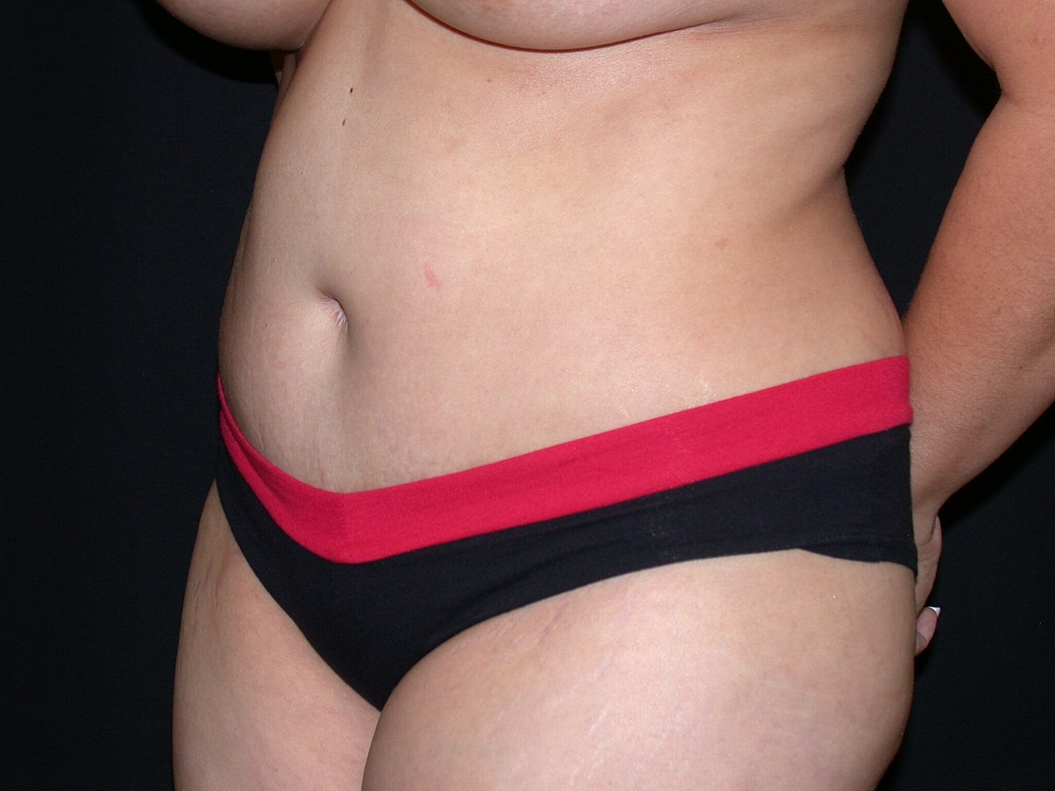 Tummy Tuck Before & After