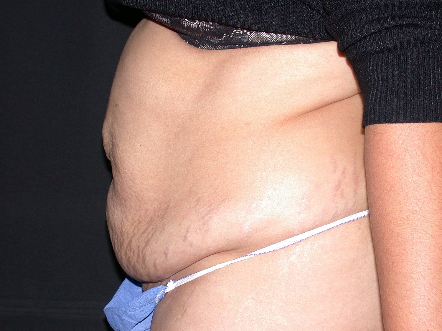 Tummy Tuck Before & After