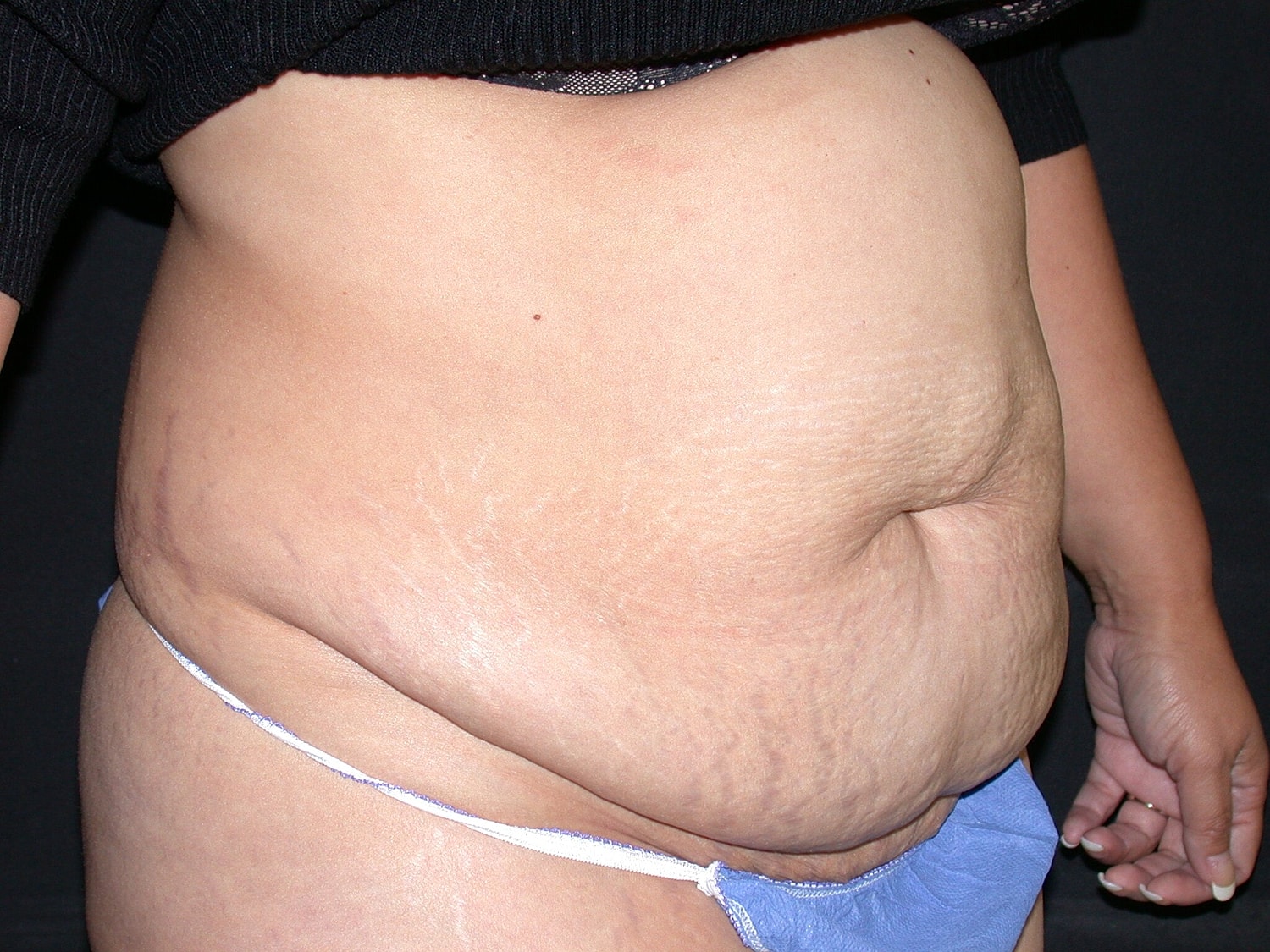 Tummy Tuck Before & After