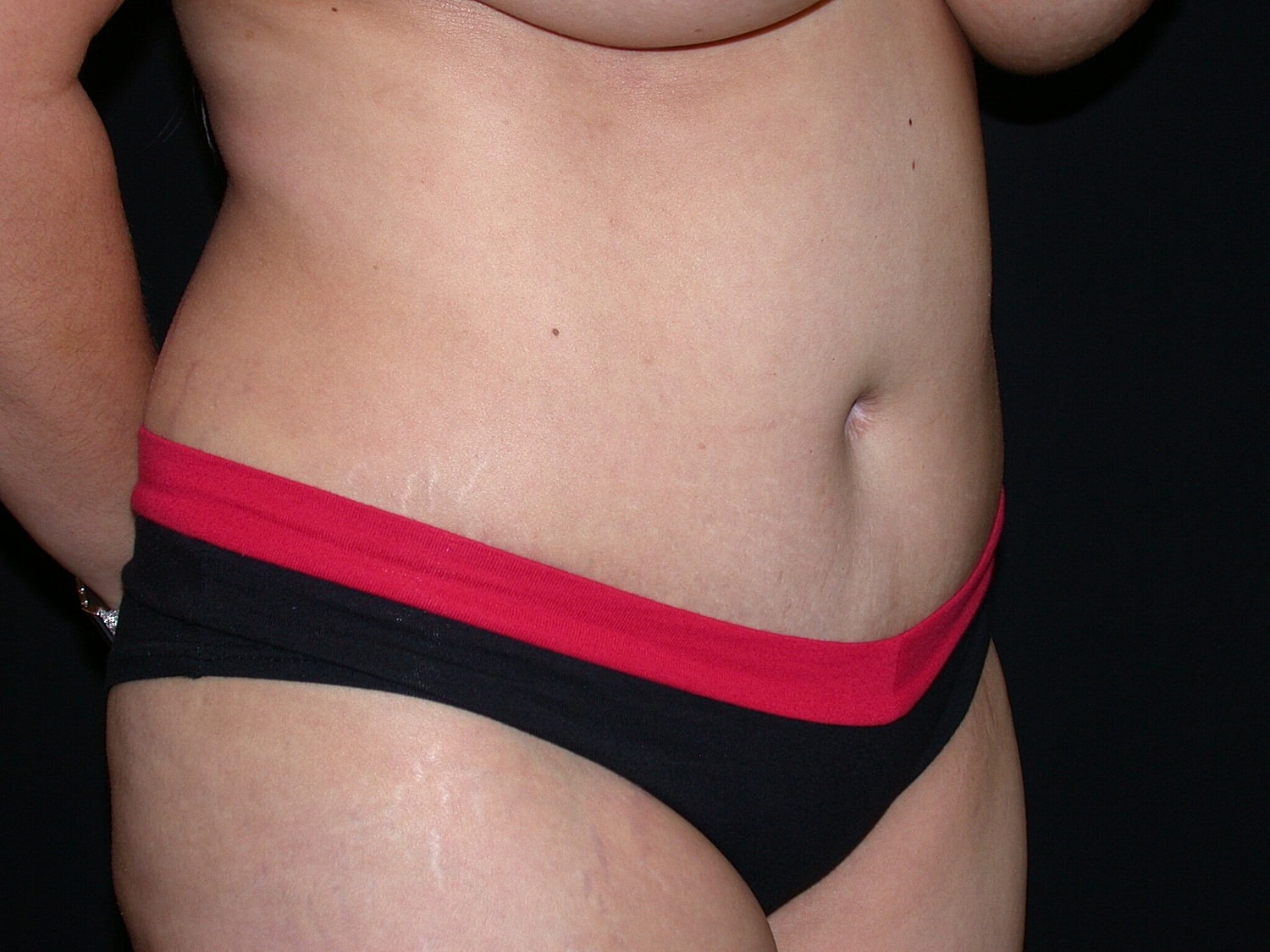 Tummy Tuck Before & After