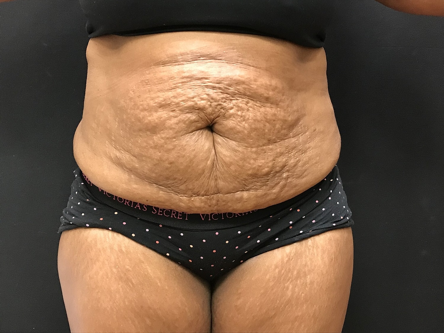 Tummy Tuck Before & After