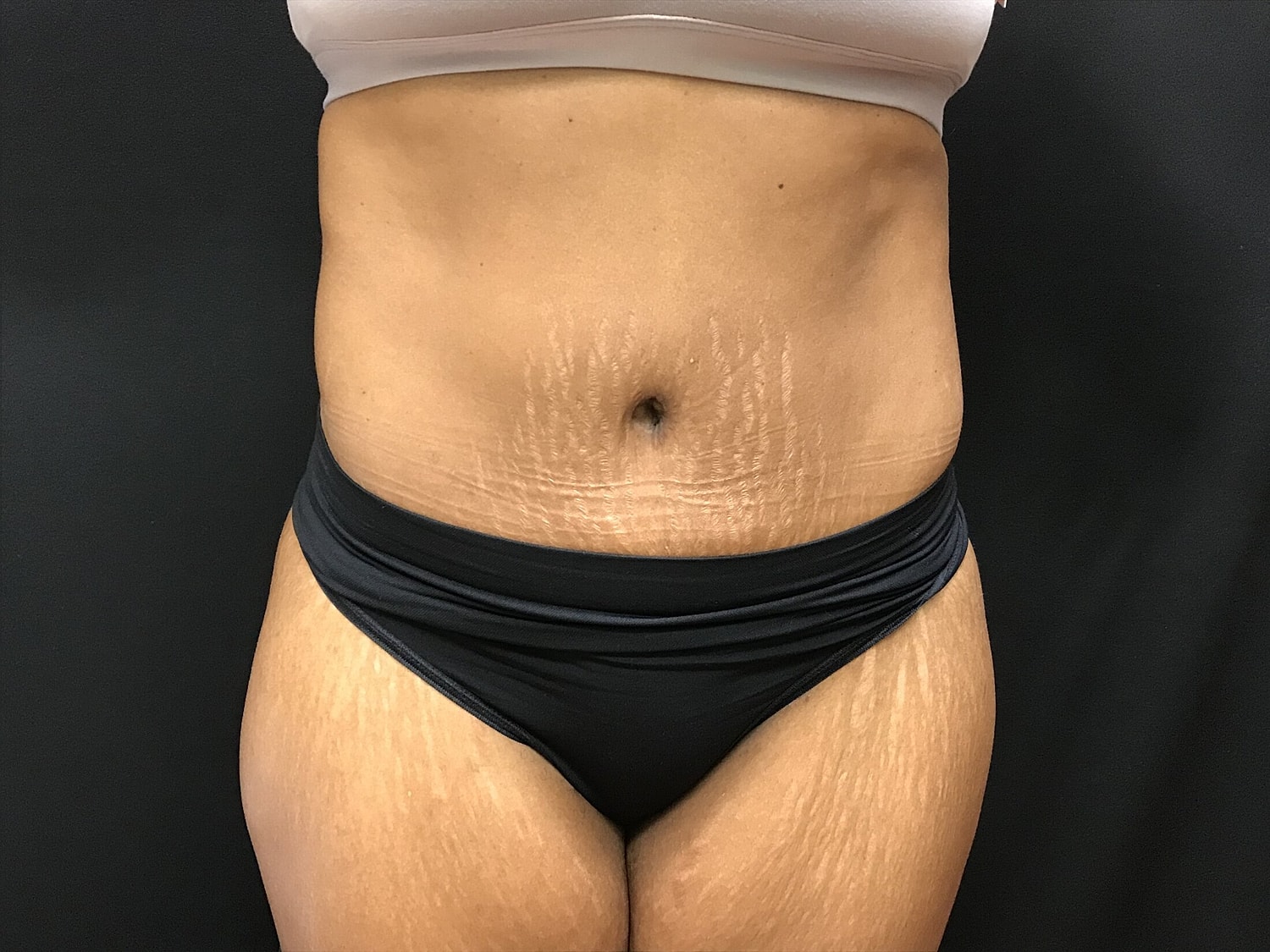 Tummy Tuck Before & After