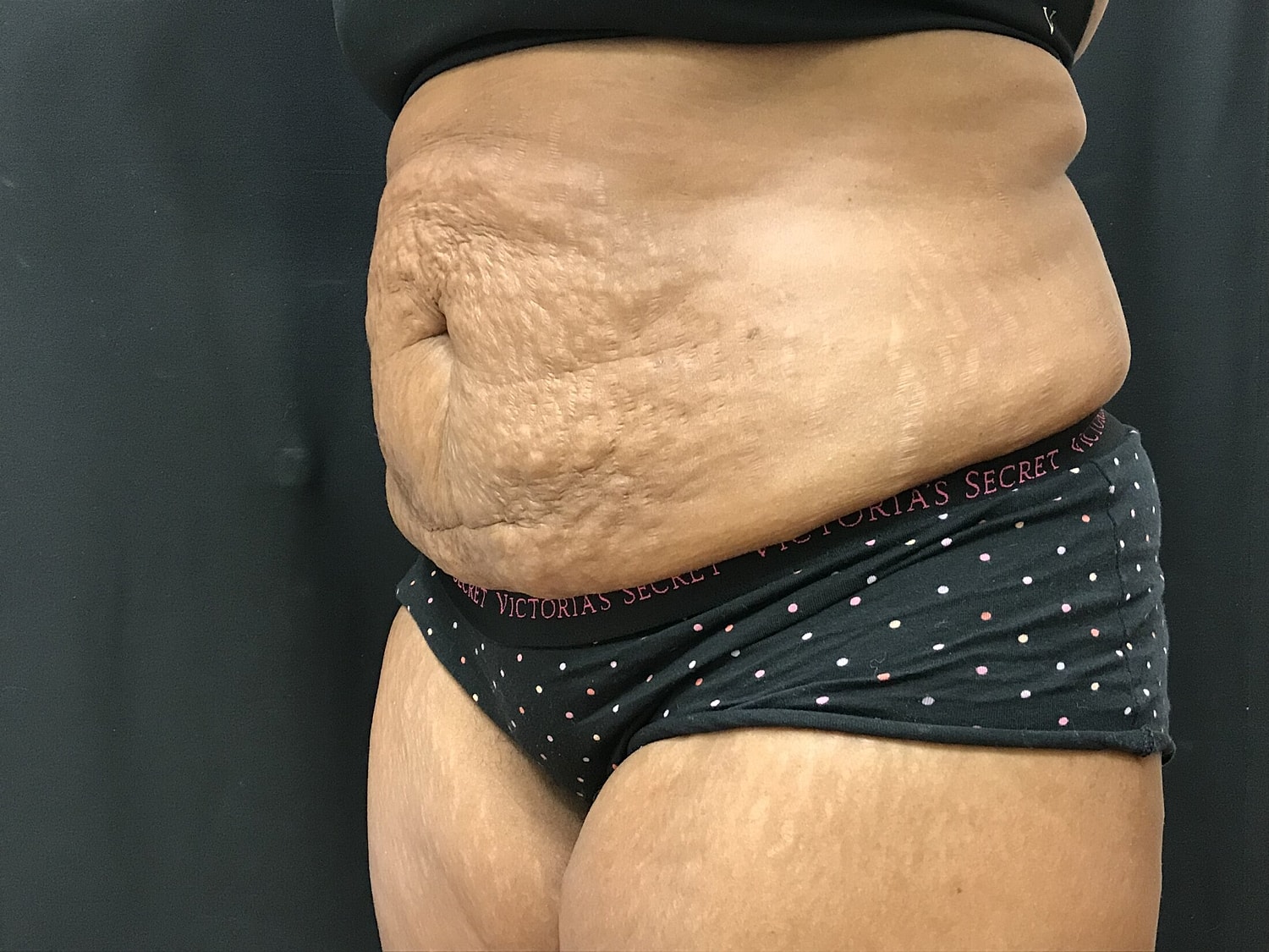Tummy Tuck Before & After