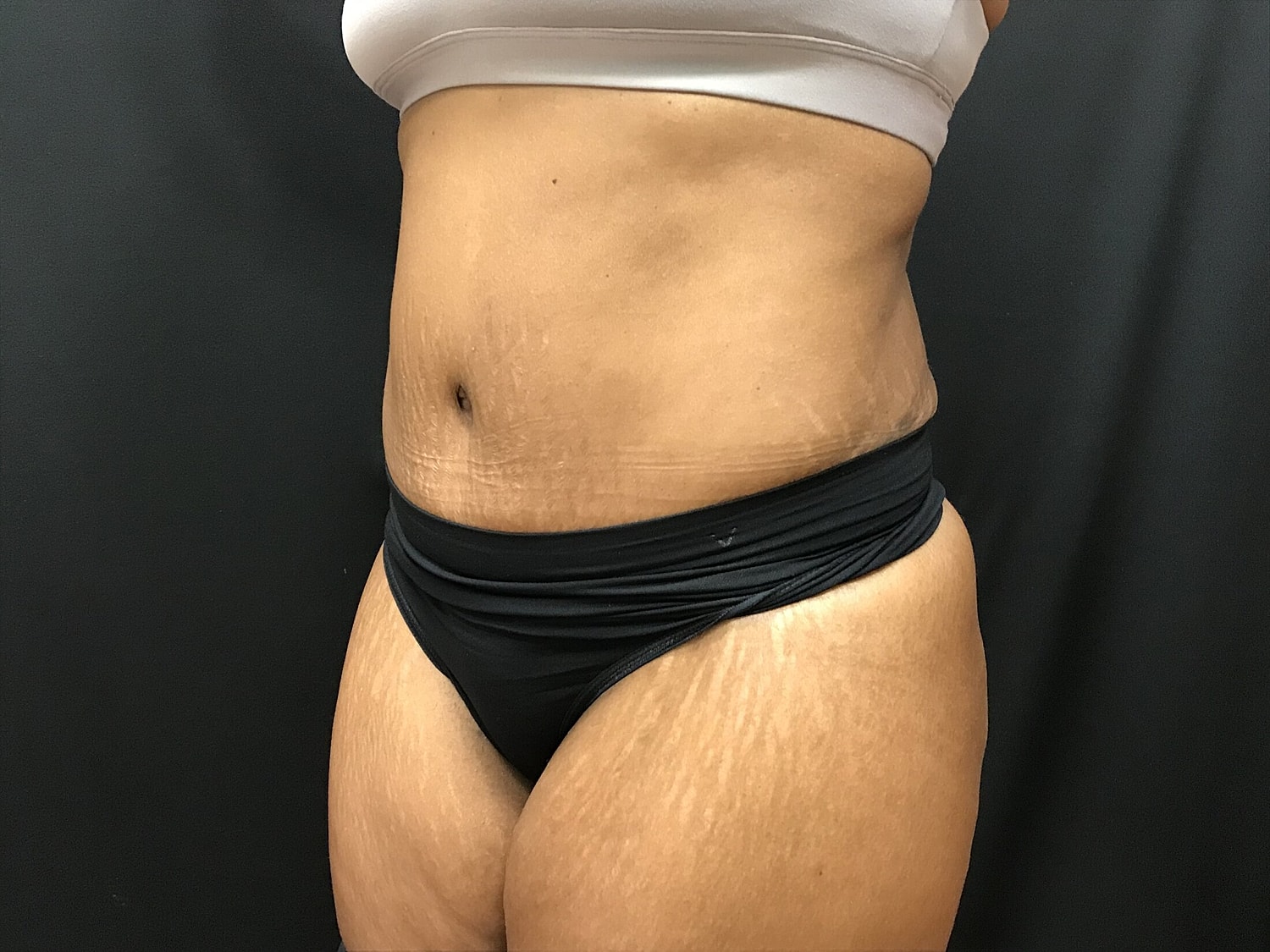 Tummy Tuck Before & After