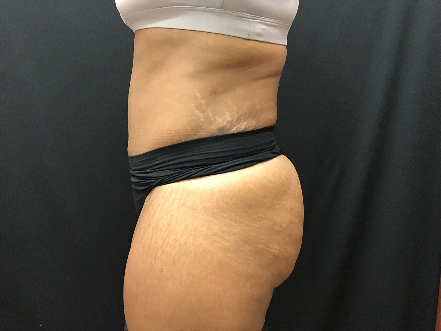 Tummy Tuck Before & After