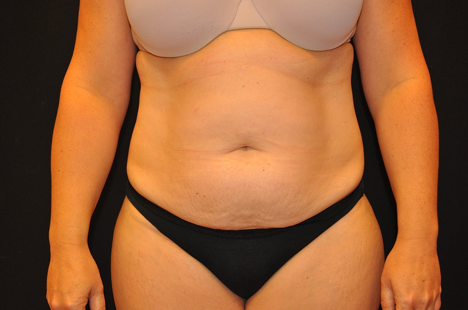 Tummy Tuck Before & After