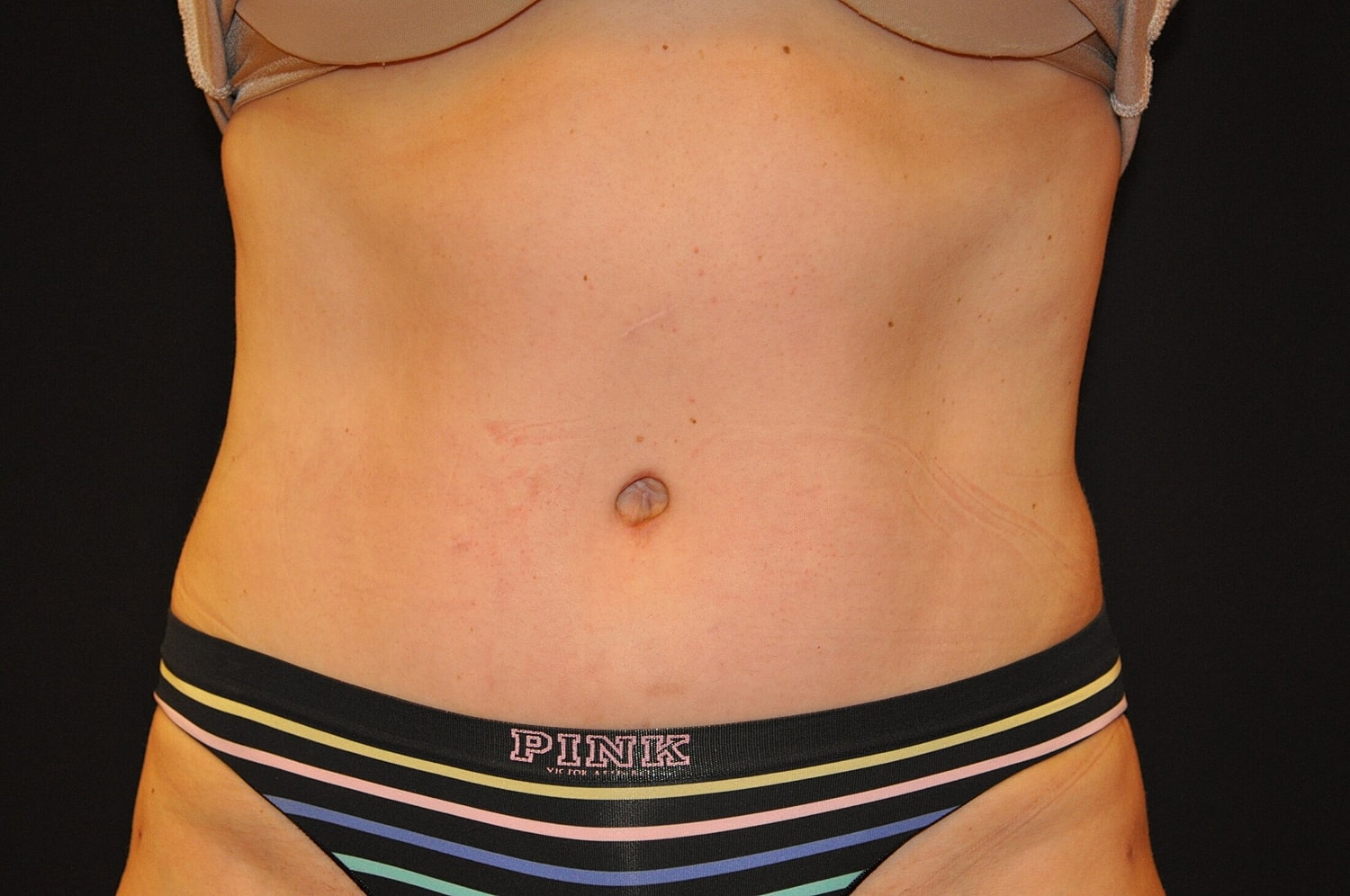 Tummy Tuck Before & After