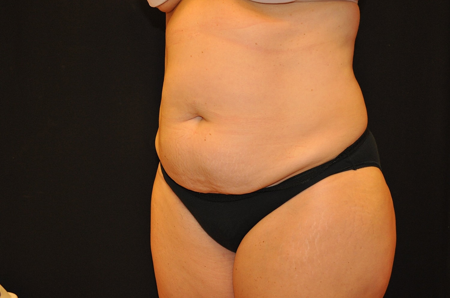 Tummy Tuck Before & After