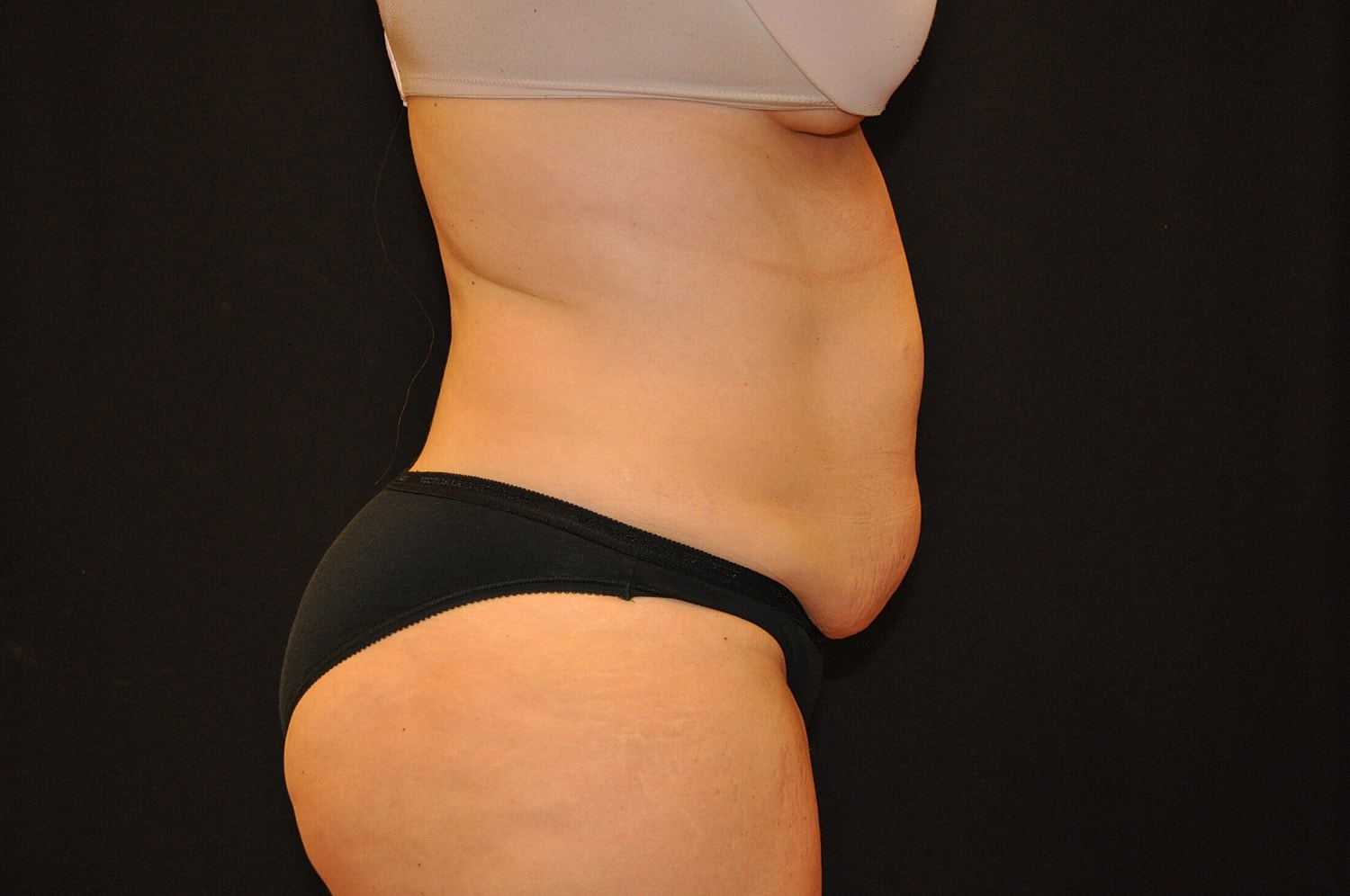 Tummy Tuck Before & After