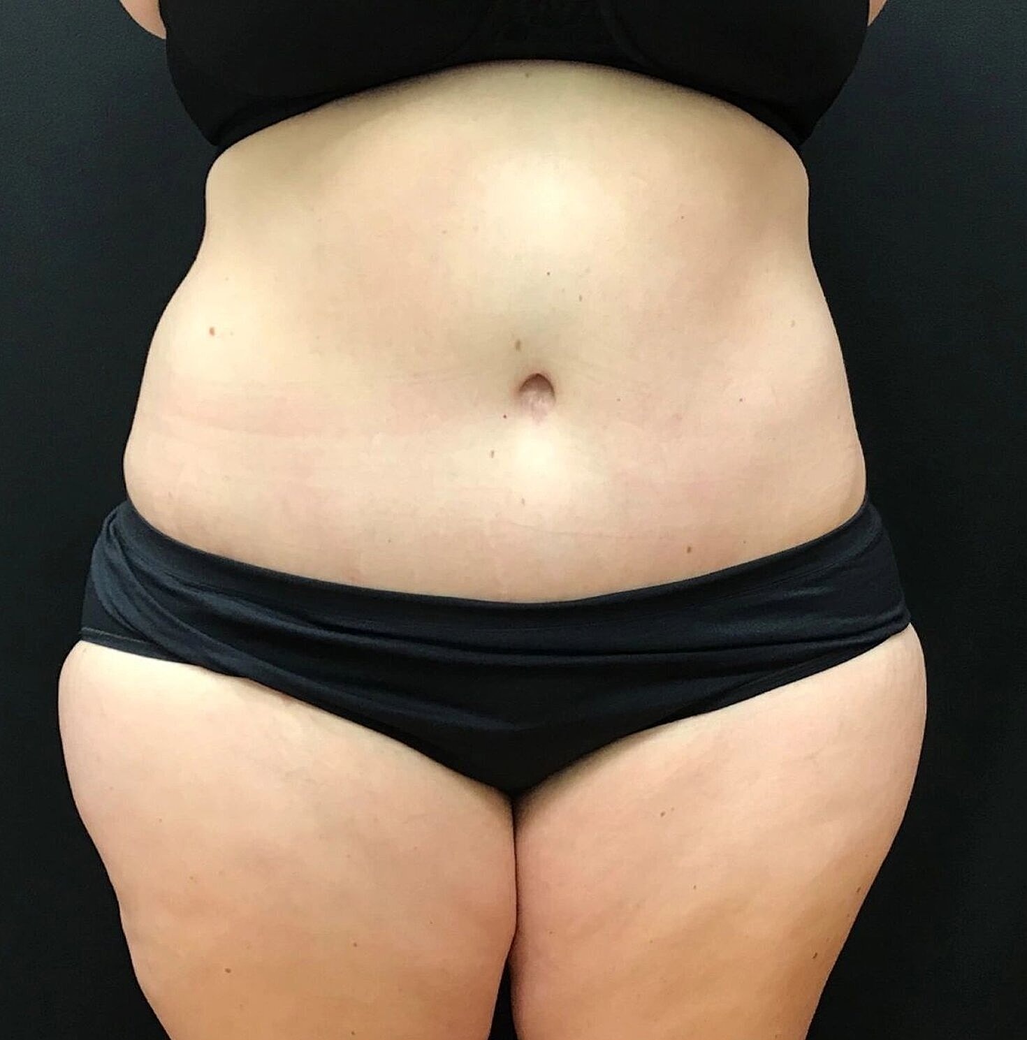 Tummy Tuck Before & After
