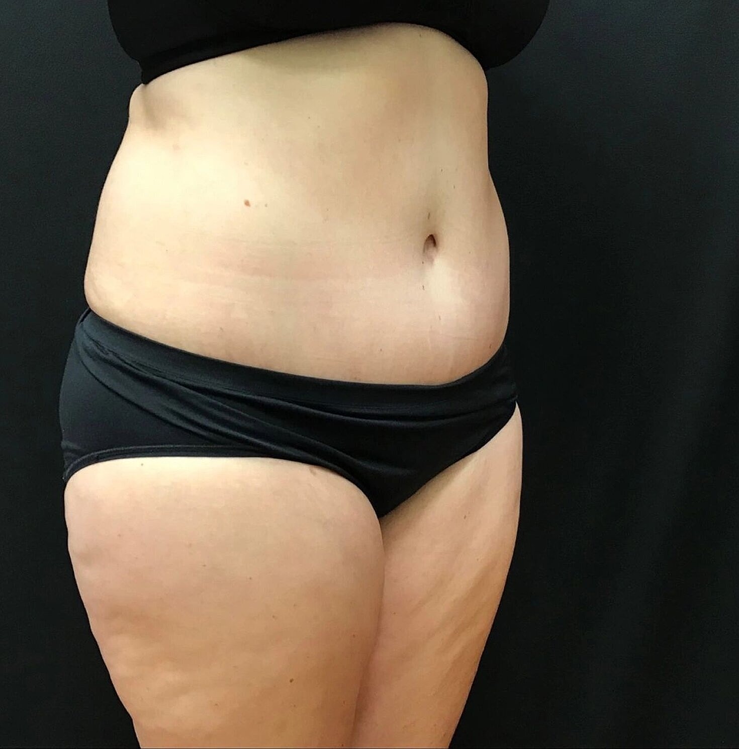 Tummy Tuck Before & After