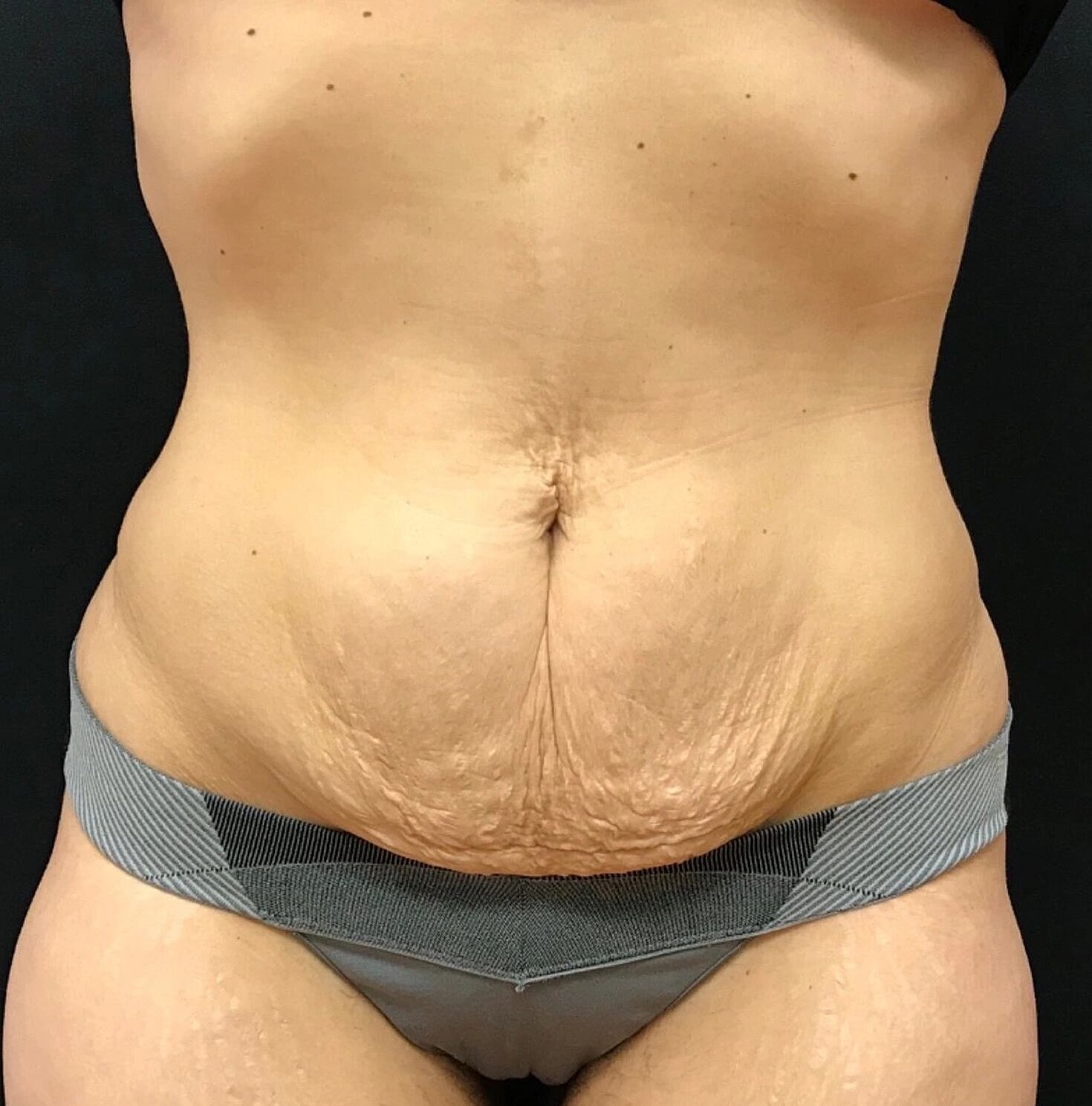 Tummy Tuck Before & After