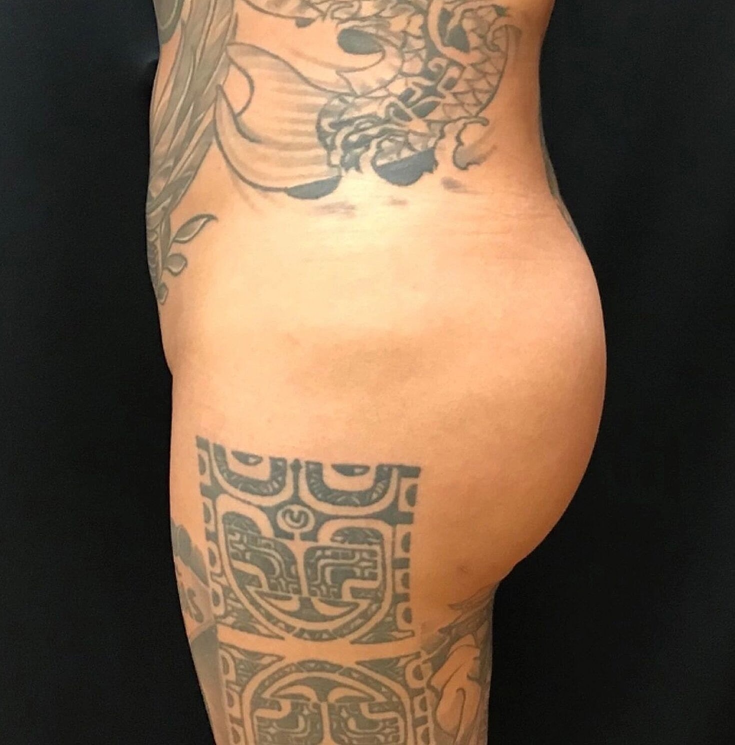 Butt Implants Before & After