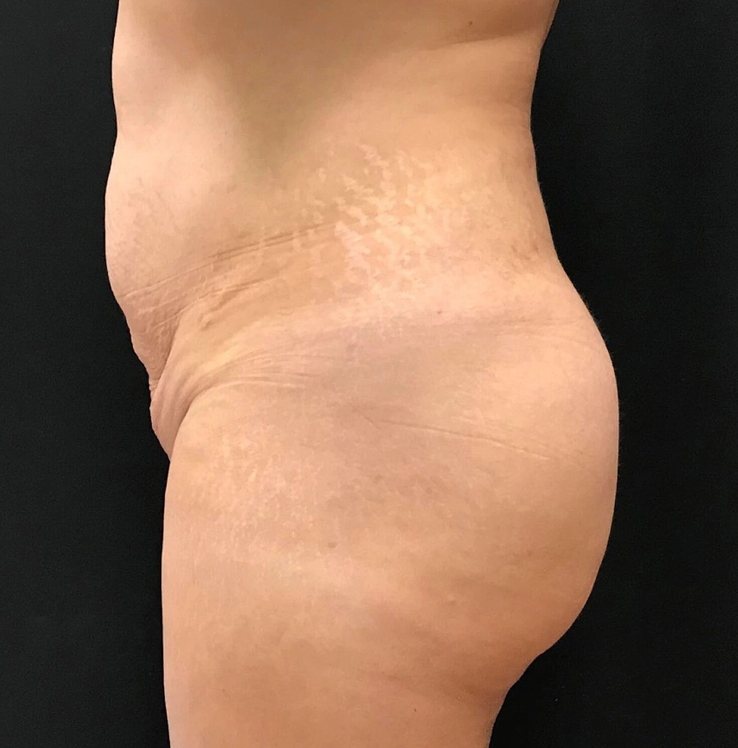 Butt Implants Before & After