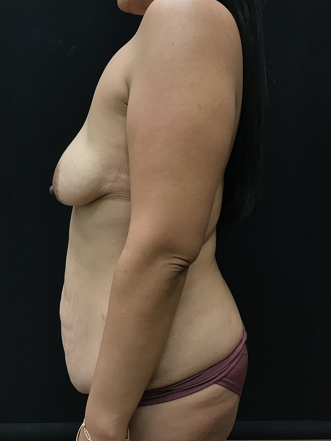 Mommy Makeover Before & After