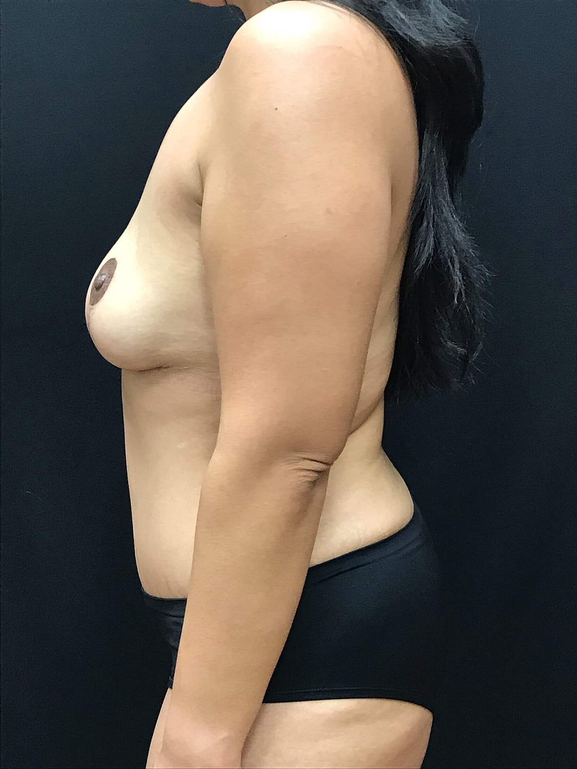 Mommy Makeover Before & After