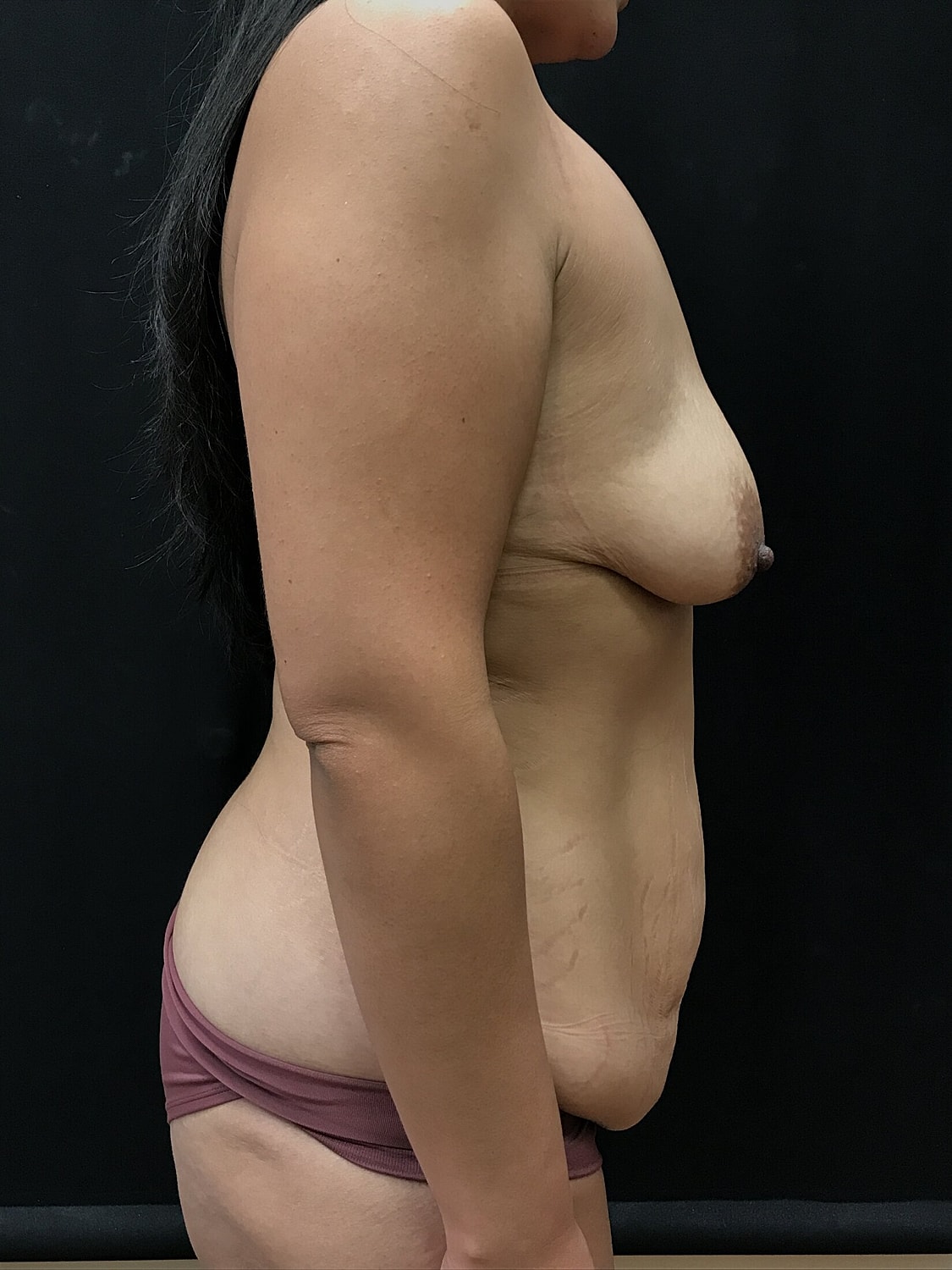 Mommy Makeover Before & After