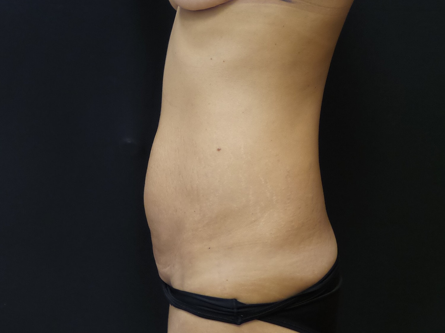 Mommy Makeover Before & After