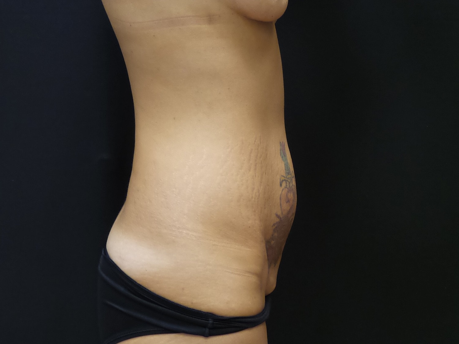 Mommy Makeover Before & After