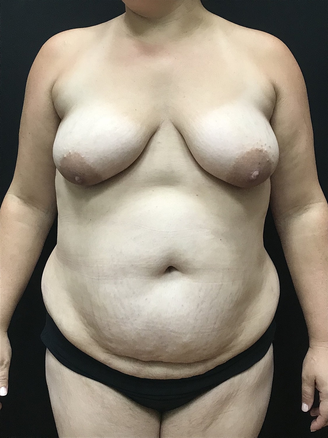 Mommy Makeover Before & After