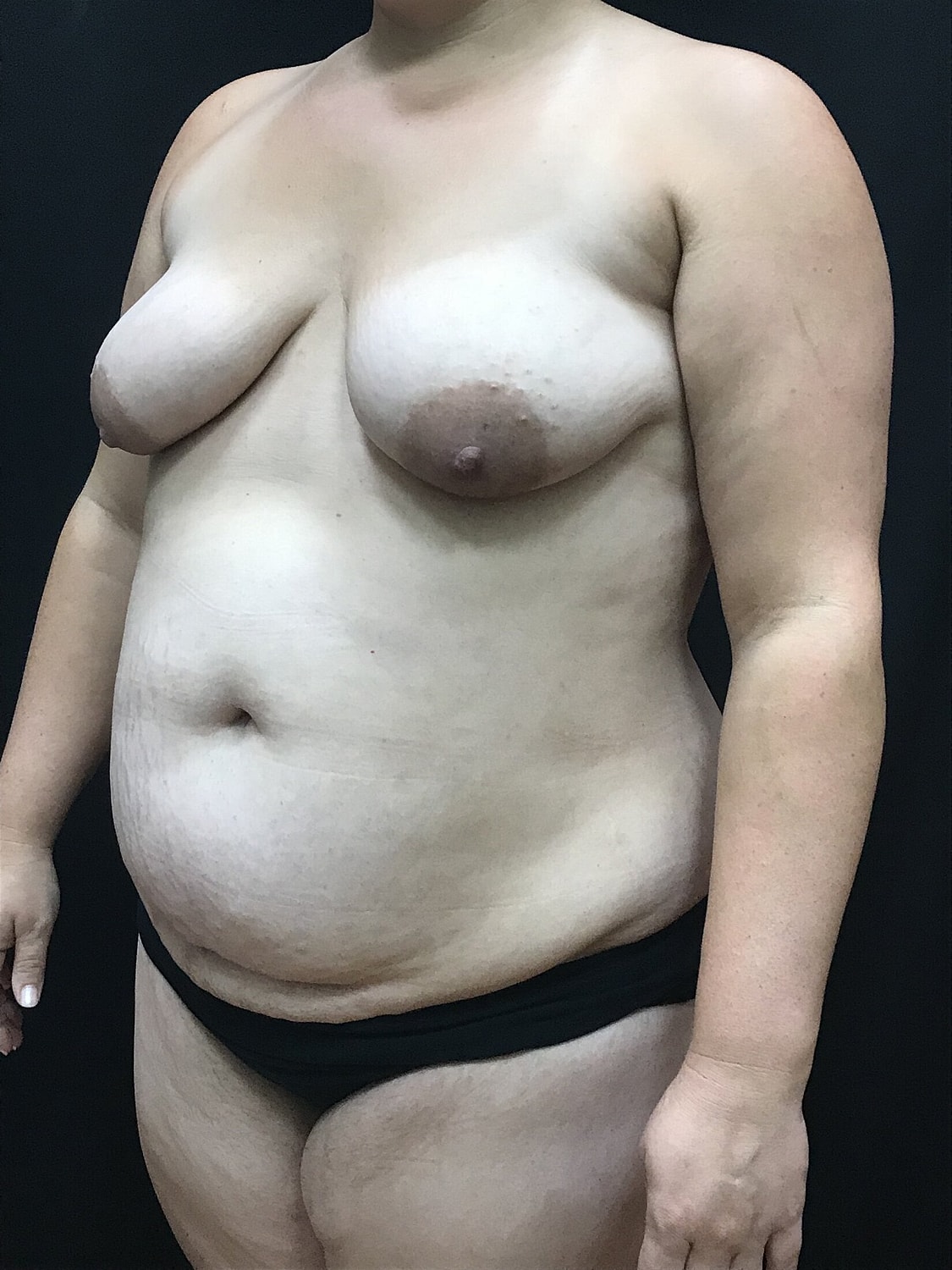 Mommy Makeover Before & After