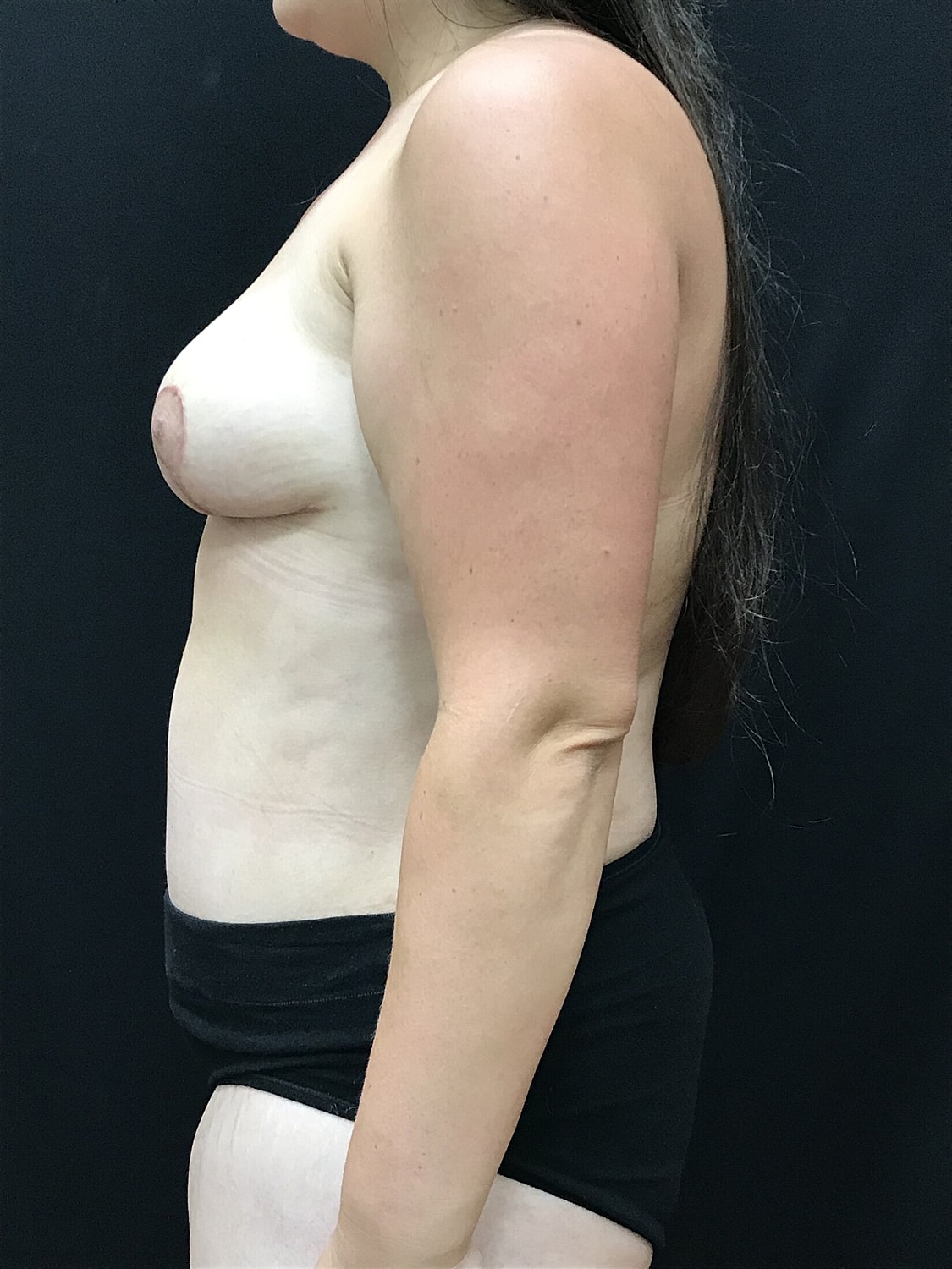 Mommy Makeover Before & After