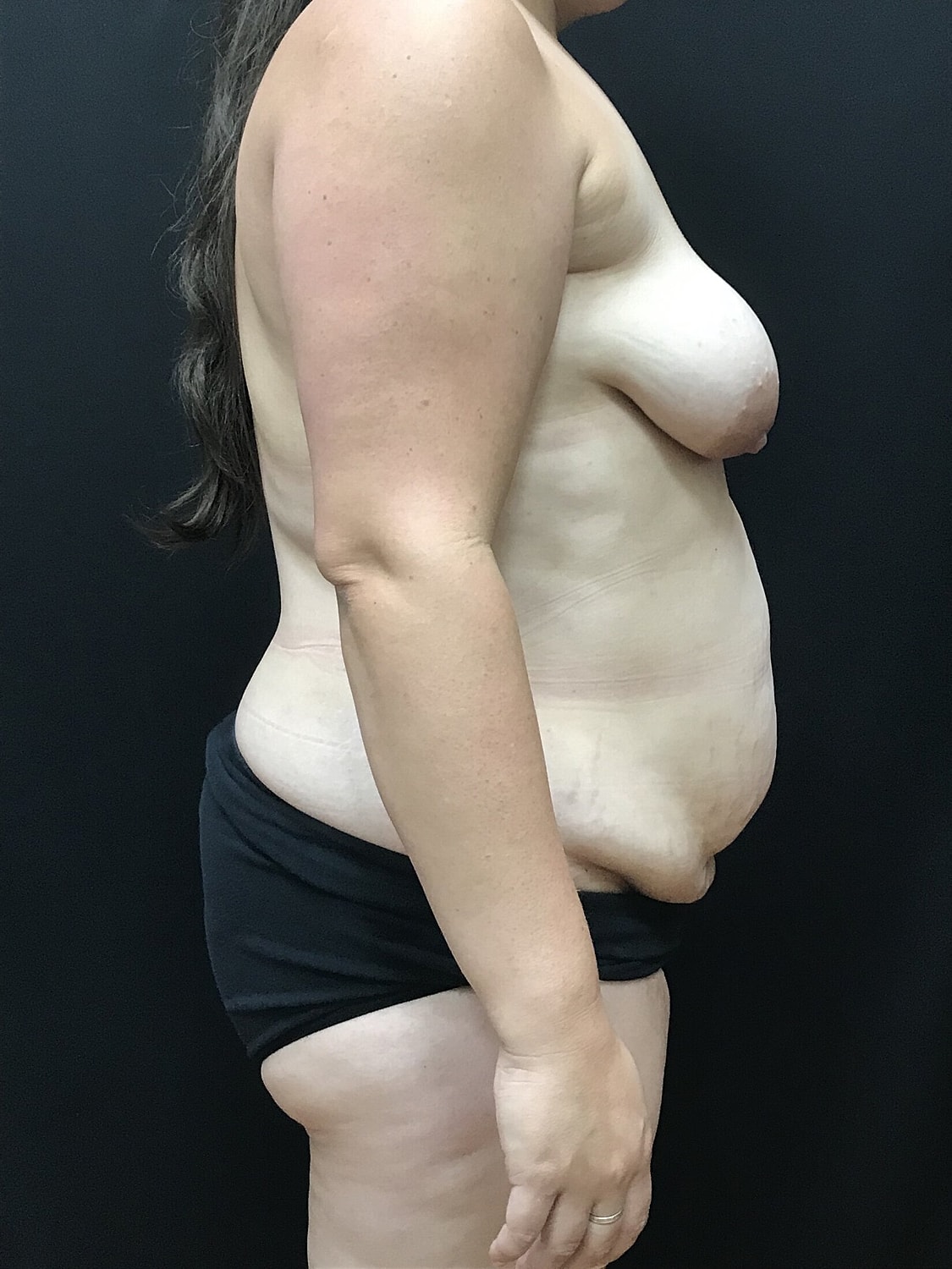 Mommy Makeover Before & After