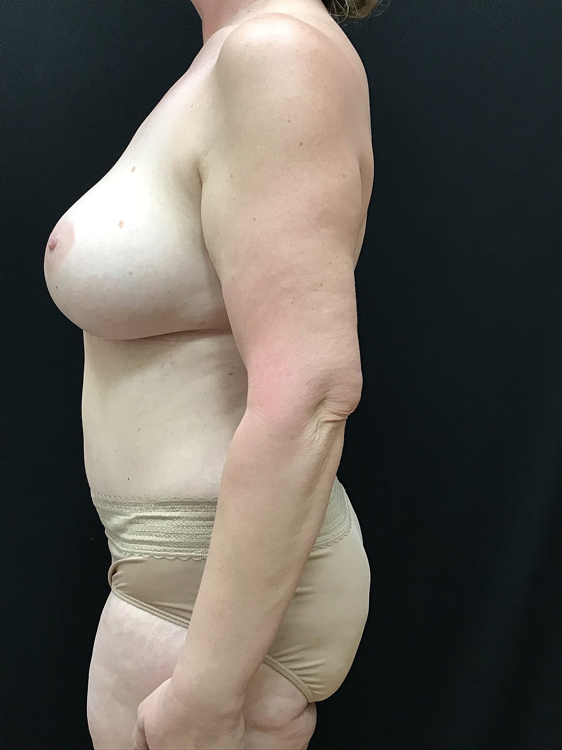 Mommy Makeover Before & After